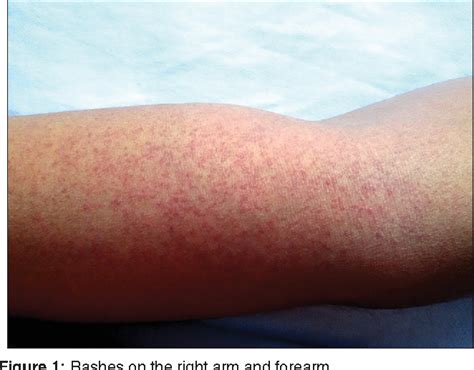 abilify rash|does abilify cause tiredness.